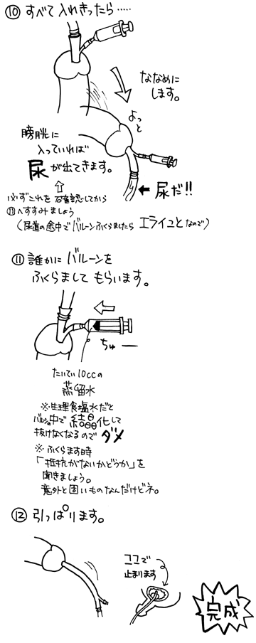 留置 バルーン カテーテル